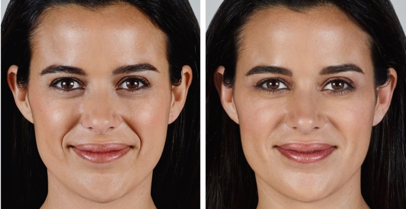 Woman before (left) and after (right) fillers The consequences of filler injection