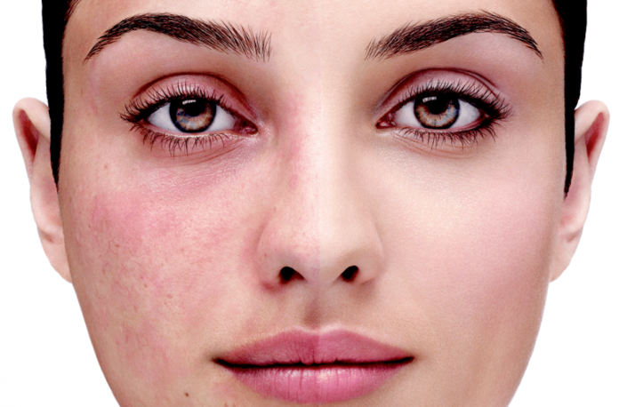 How to choose a cream for redness on the face? How to choose a cream for redness on the face?