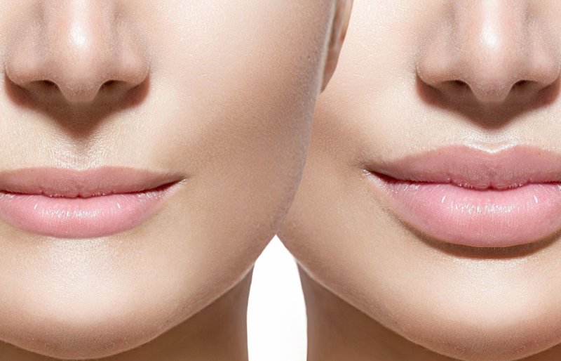 Lips before and after enlargement with hyaluronic acid