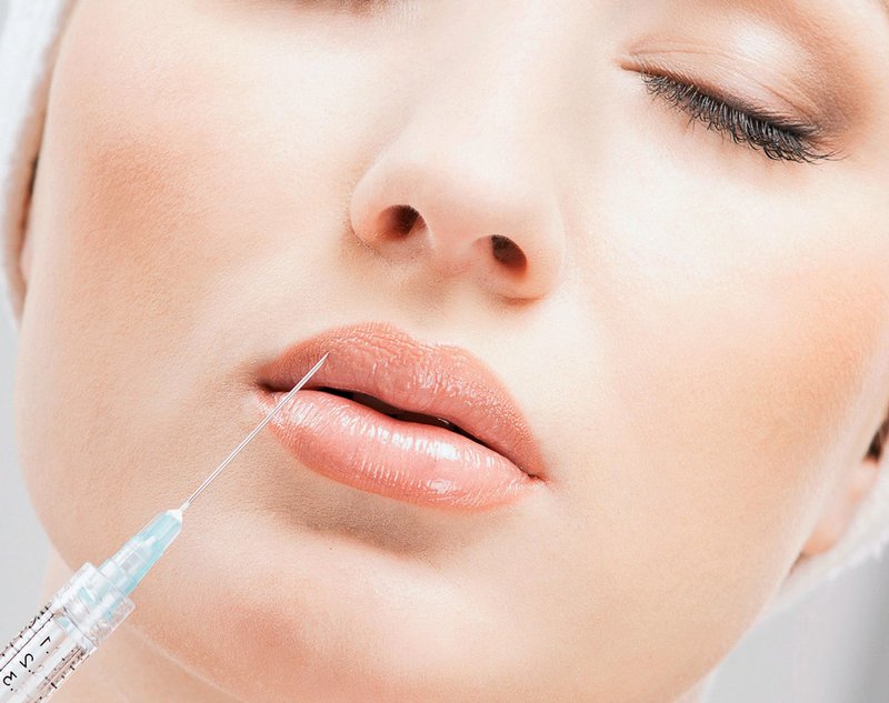 Lip augmentation with hyaluronic acid