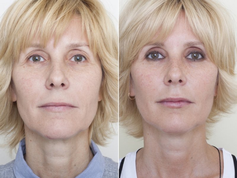 Thread Lift: Customer Reviews Thread Lift: Customer Reviews