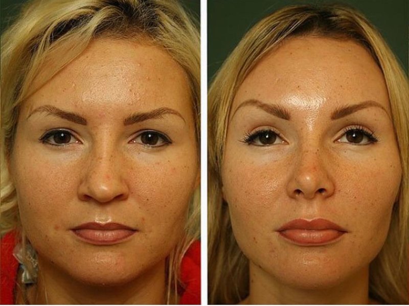 Reviews on the use of thread lifting with a photo Reviews on the use of thread lifting with a photo