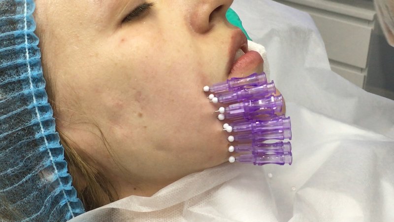 Swelling after facelift with threads Swelling after facelift with threads