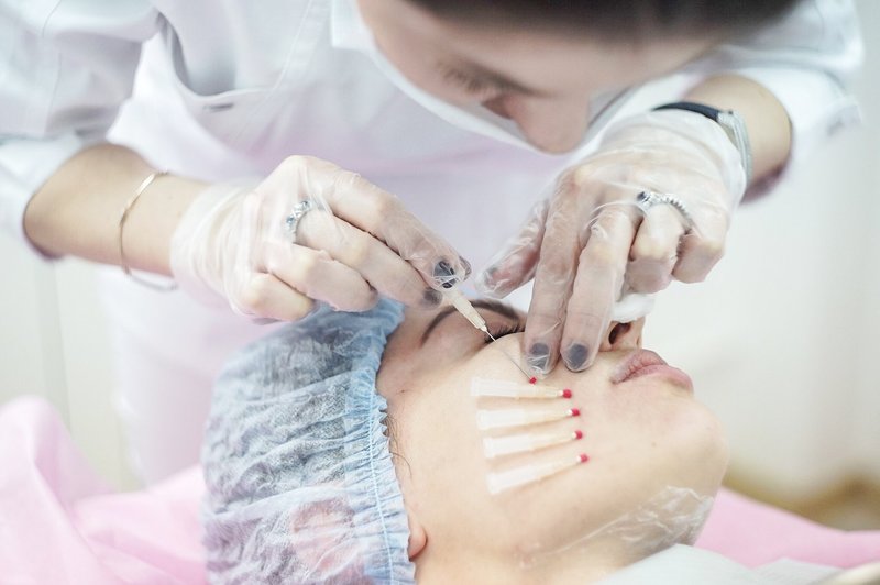 Thread lifting Thread lifting