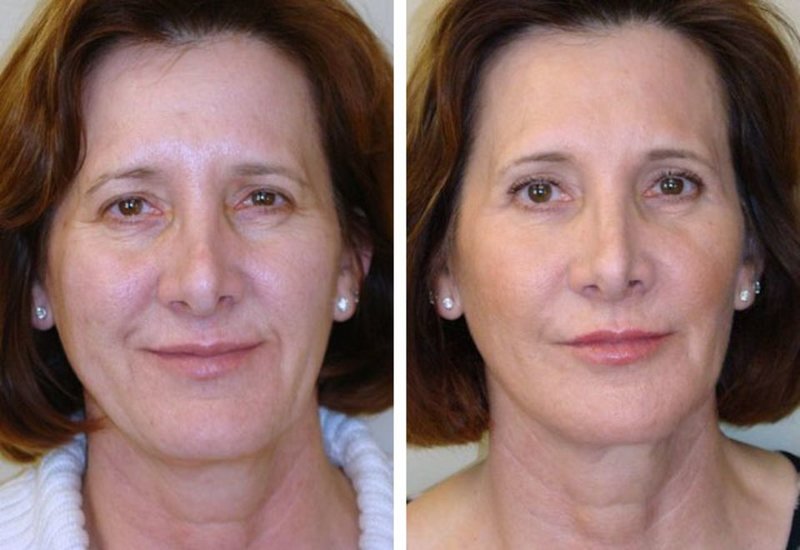 The effect before and after biorevitalization The effect before and after biorevitalization