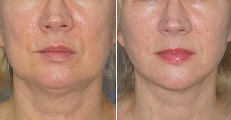 SMAS lifting result SMAS lifting result