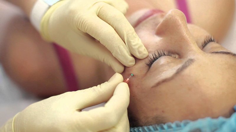 Thread lifting: procedure steps Thread lifting: procedure steps