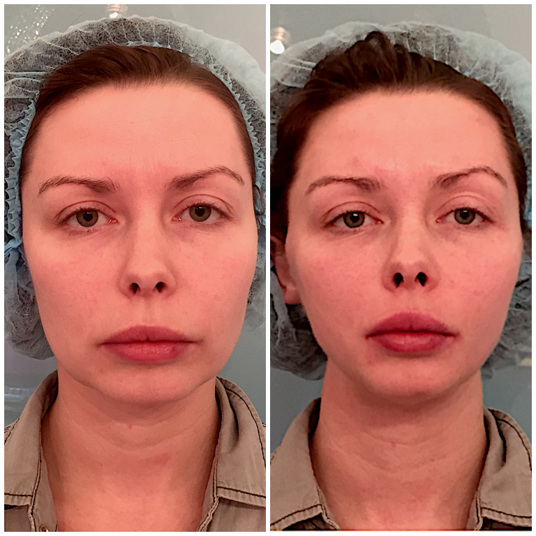 Thread facelift: before and after photos Thread facelift: before and after photos