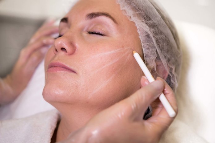 Thread Lift Thread Lift