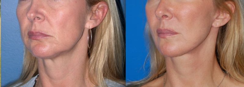 Maisonette facelift: real reviews Maisonette facelift: real reviews