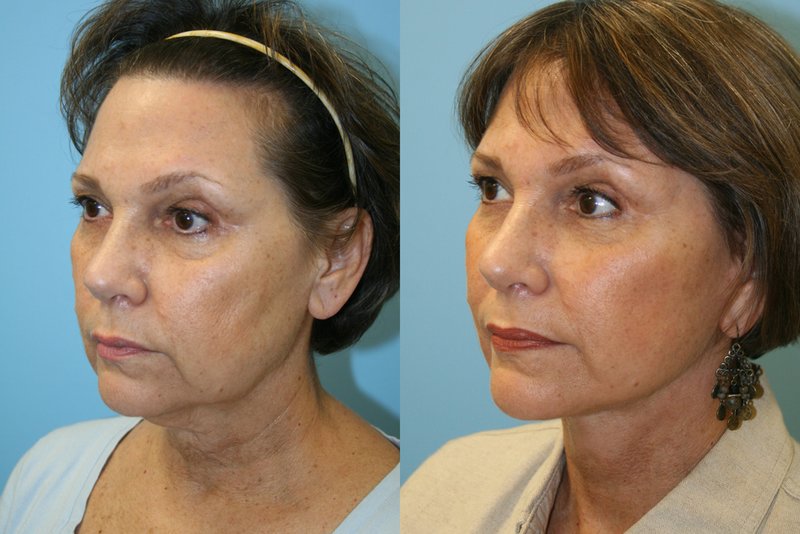 Thread Lifting Results Thread Lifting Results