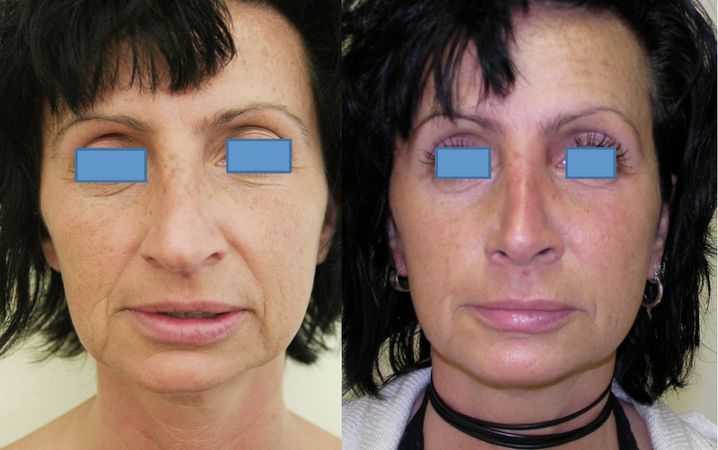 Smas lifting before and after photos Smas lifting before and after photos