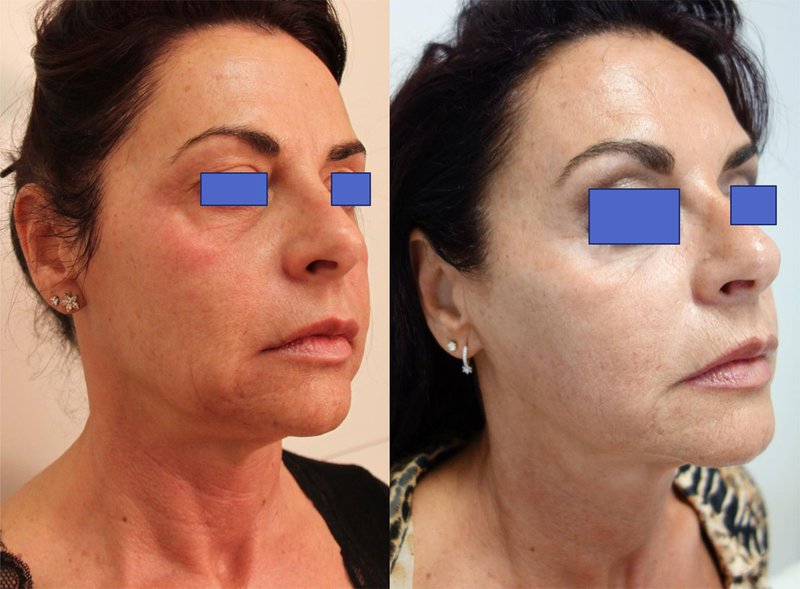 Result after smas-lifting Result after smas-lifting