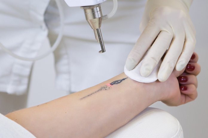 Laser tattoo removal Laser tattoo removal